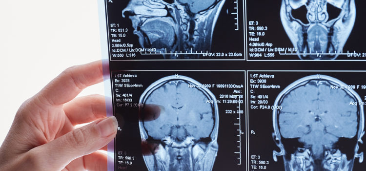 Brain Injury Lawyers Tampa Bay Florida