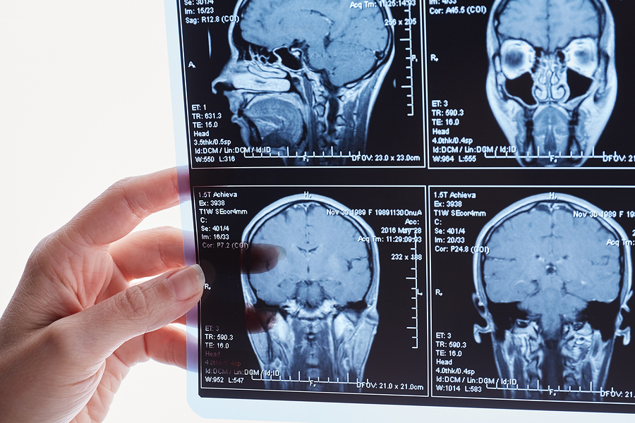 Brain Injury Lawyers Tampa Bay Florida