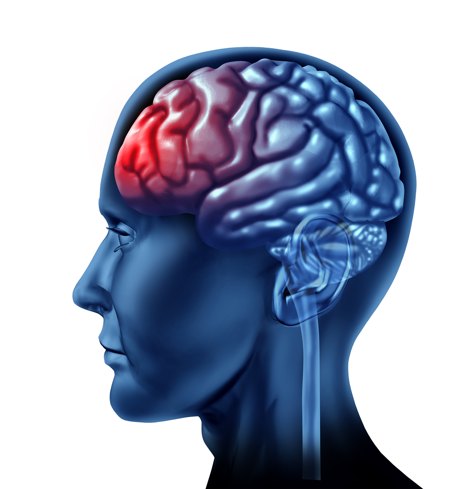 Brain Injury Lawyers in Tampa Bay, Florida