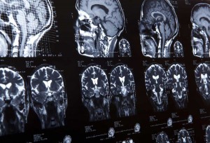 Brain Injury Lawyers in Tampa Bay