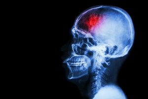 "Stroke" (cerebrovascular accident)