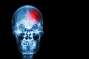 Stroke ( Cerebrovascular Accident ) . Film X-ray Skull Of Human